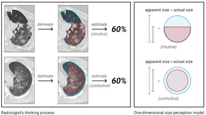 Figure from “Evidence of a cognitive bias in the quantification of COVID-19 with CT: an artificial intelligence randomised clinical trial”