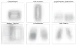 Revised Set Prediction Matching for Chest X-ray Pathology Detection with Transformers