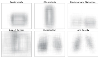 Revised Set Prediction Matching for Chest X-ray Pathology Detection with Transformers